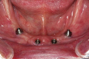 インプラント＋入れ歯の症例