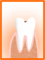 虫歯の進行1